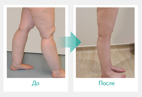 Аппарат прессотерапии Doctor life Mark 400 (Южная Корея) фото 5