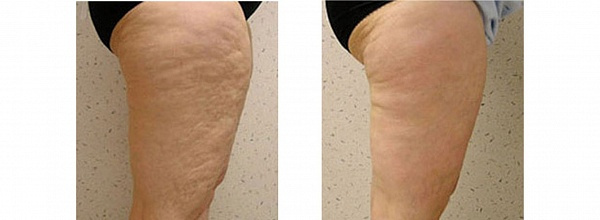 F-XBC Body Комплекс для тела, 10мл фото 4